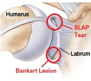 https://www.shoulder-pain-explained.com/images/Shoulder-Labrum-Tears.jpg