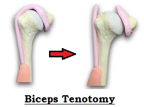 biceps tenotomy tendonitis bicep