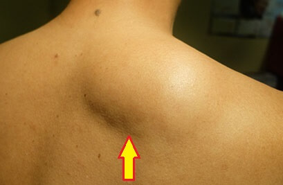 Bump Or Lump On Back Of Shoulder: Causes, Symptoms & Treatment