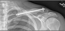 Clavicle Fracture: Symptoms, Diagnosis & Treatment