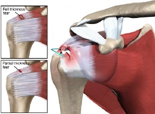 Shoulder Pain Explained: Understand It and Treat It