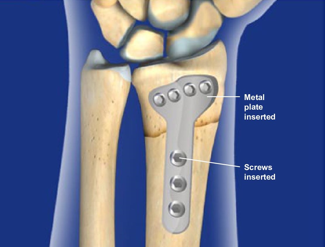 Distal Radius Fracture Causes And Treatment For Wrist Fractures 6324