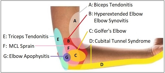 Elbow Pain Diagram Diagnosis Chart