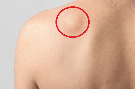 Bump Or Lump On Back Of Shoulder: Causes, Symptoms & Treatment