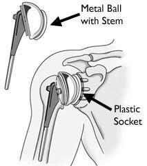 Proximal Humerus Fracture: Causes, Treatment & Recovery