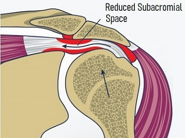 Shoulder Pain At Night - Causes & Treatment