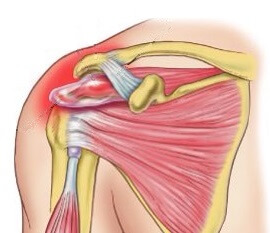 Алкоголизация Supraspinatus