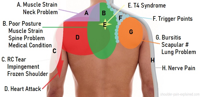 Shoulder Pain Diagnosis Symptom Chart