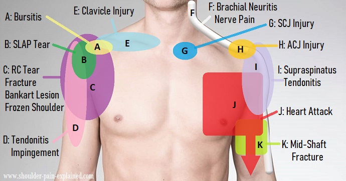 Shoulder Pain Diagram Diagnosis Chart Shoulder Pain Exp