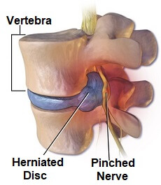 Spinal disc disease such as a herniated disc can place pressure on the nerve and result in shoulder blade pain