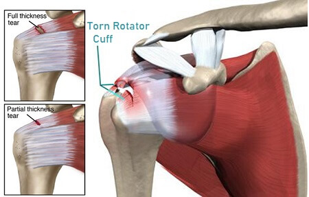 partially torn rotator cuff symptoms