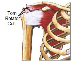 A rotator cuff tear can lead to shoulder blade pain