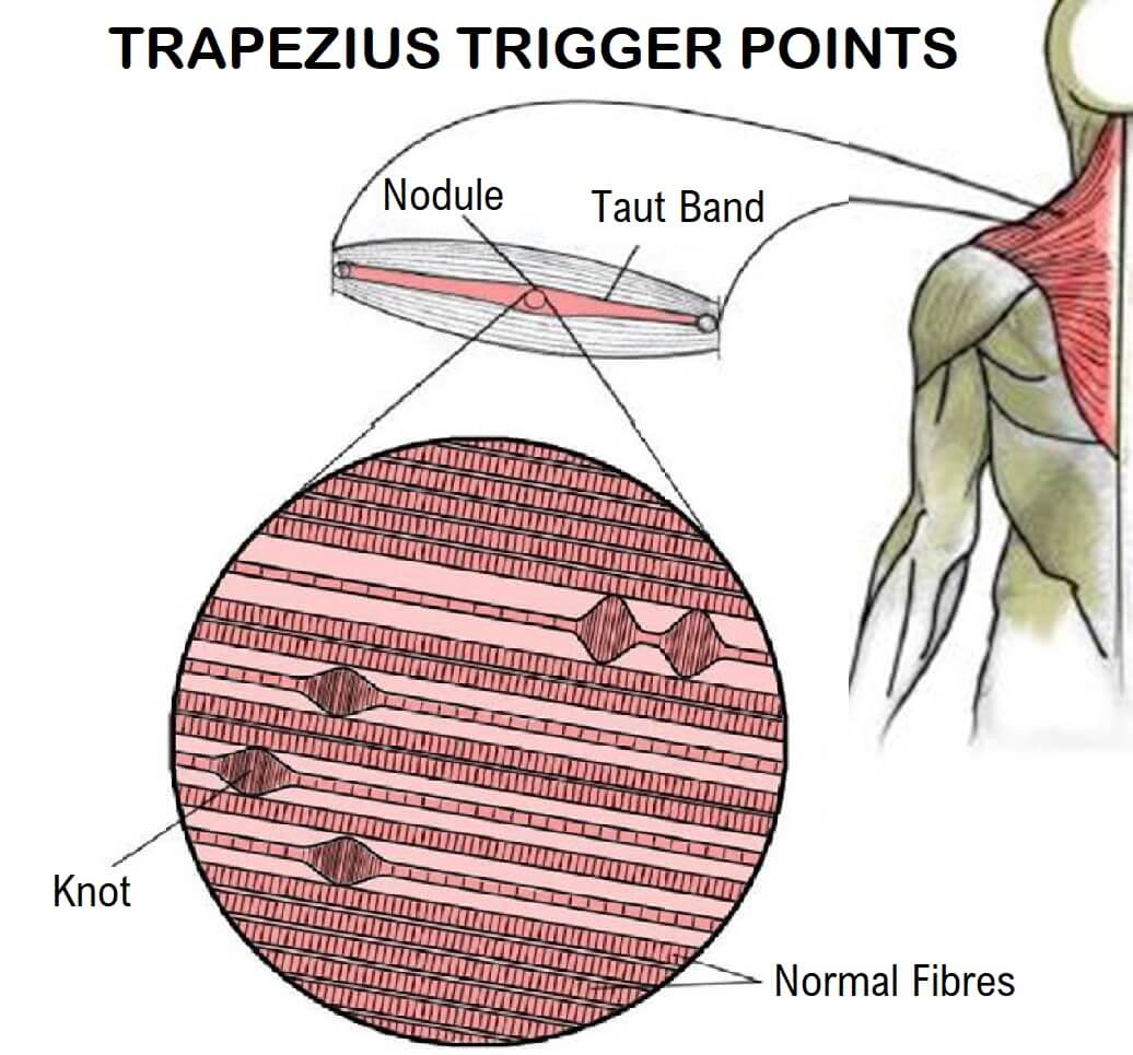 trapezius trigger points