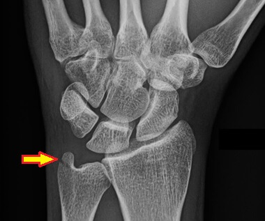 Ulnar Styloid Fracture: Causes, Symptoms & Treatment