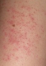 Arm & Shoulder Acne: Causes & Treatment