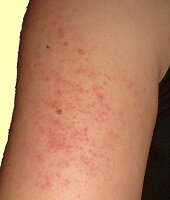 Keratosis Pilaris Treatment