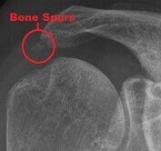 Subacromial Decompression Surgery For Shoulder Impingement