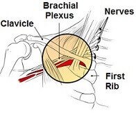 Burning Shoulder Pain