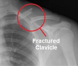 Clavicle Fracture: Symptoms, Diagnosis & Treatment