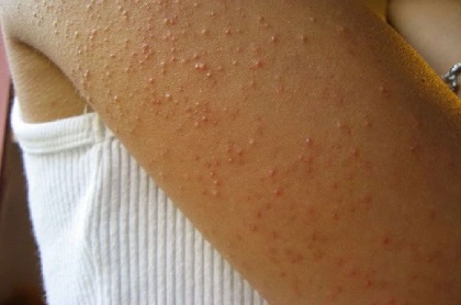 Keratosis Pilaris Treatment, Causes & Symptoms