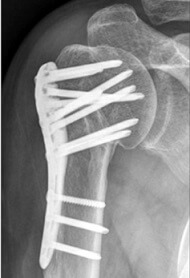 Proximal Humerus Fracture: Causes, Treatment & Recovery