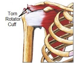 Upper Arm Pain: Causes, Diagnosis & Treatment